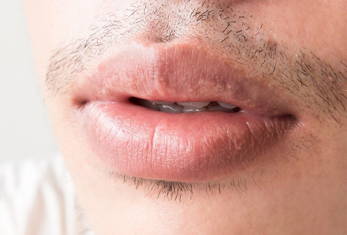 होठों पर Fordyce धब्बे: कारण, लक्षण, निदान और उपचार - %श्रेणियाँ