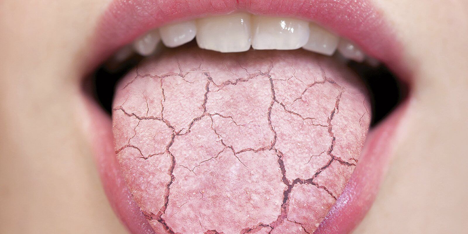 جفاف الفم: الأسباب والأعراض والتشخيص والعلاج - %categories
