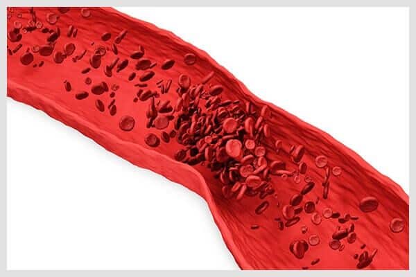 blood-clotting-skinny-jeans-may-be-harmful-1-600x400 الآثار الجانبية لارتداء الجينز الضيق