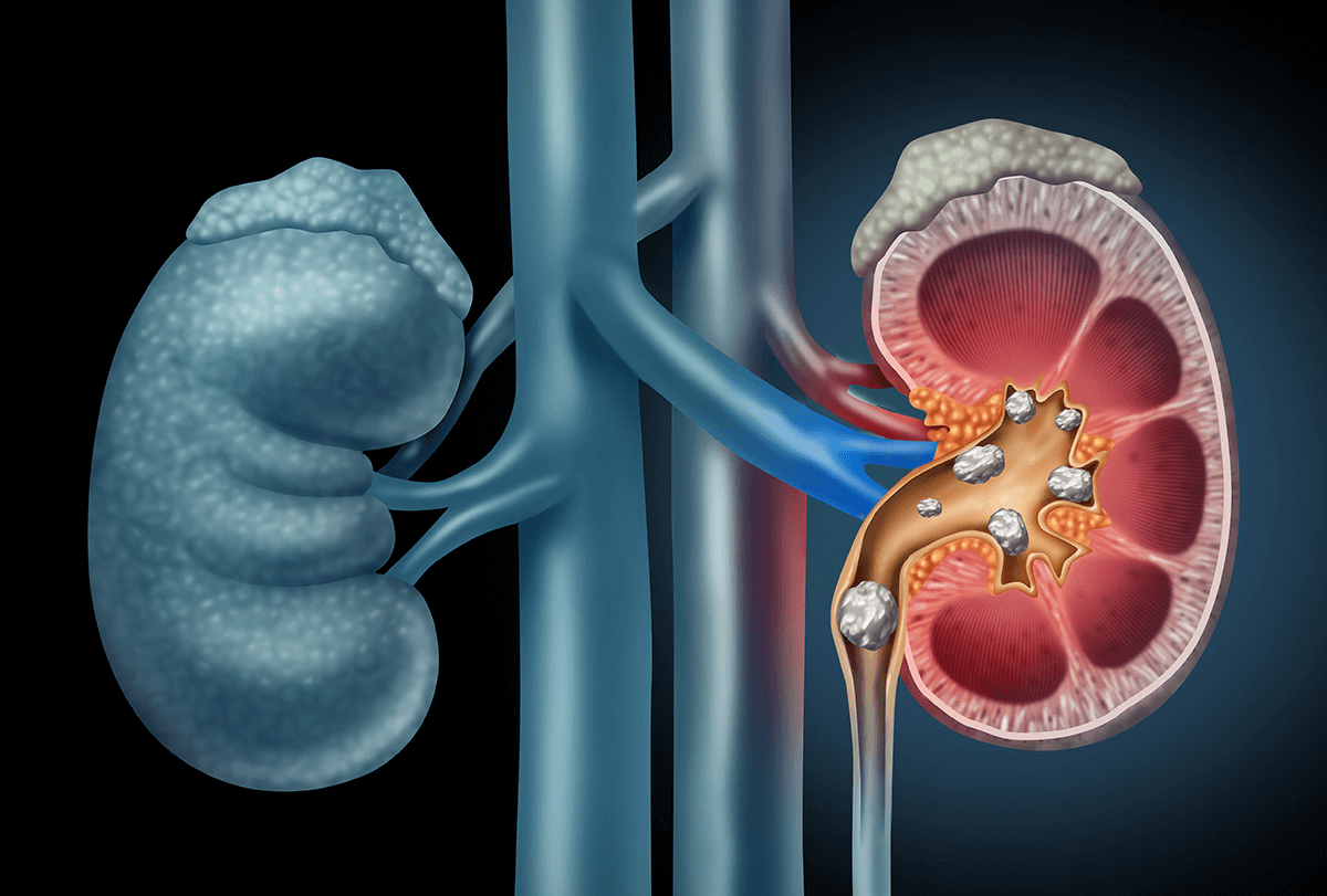 causes and symptoms of kidney stone feat - حصوات الكلى: الأسباب والأعراض والتشخيص والعلاج