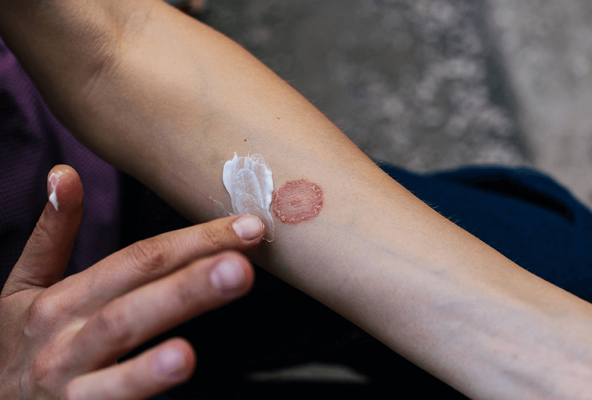 La teigne du corps : causes, symptômes et traitement - beauté de la peau causes de l'exploit de teigne du corps - Teigne du corps: causes, symptômes et traitement