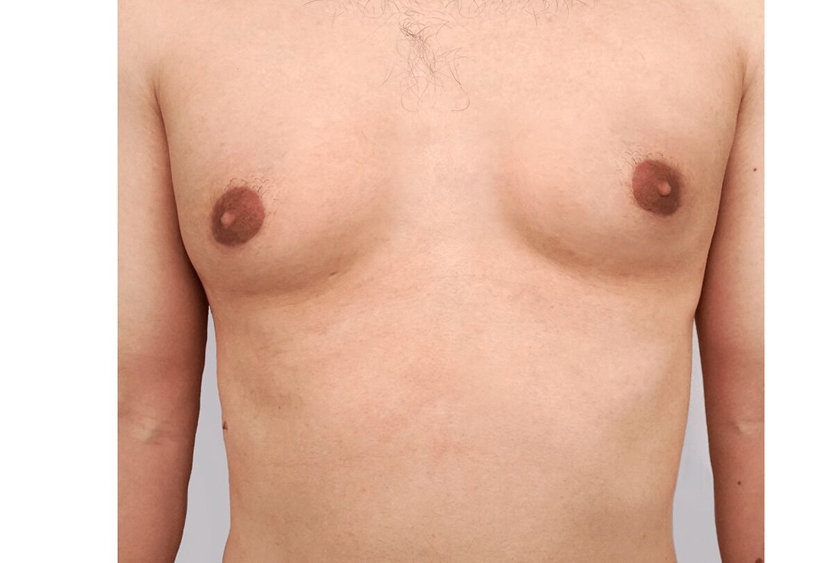 Gynäkomastie: 7 natürliche Wege, um vergrößerte Brüste bei Männern zu kontrollieren - Drüsen-Hormone Hausmittel gegen Gynäkomastie feat 1200x811 - Gynäkomastie: 7 natürliche Wege, um vergrößerte Brüste bei Männern zu kontrollieren