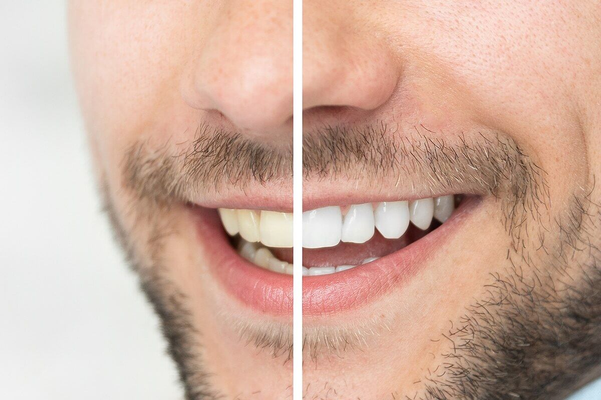 كيفية تبييض الأسنان الصفراء بشكل طبيعي - oral-health is teeth whitening safe for kids blog 1200x800 - كيفية تبييض الأسنان الصفراء بشكل طبيعي