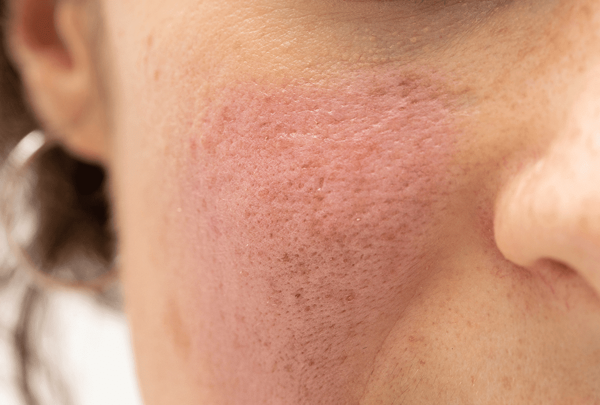 Rougeur du visage après application de glace : ses causes et ses astuces pour la prévenir - skin-beauty rougeur sur le visage feat - Rougeur du visage après application de glace : ses causes et ses astuces pour la prévenir