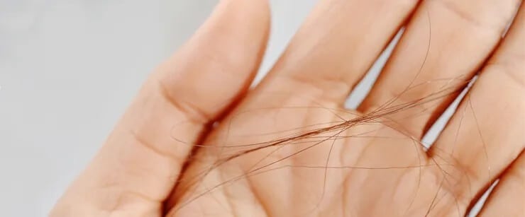 Hair Loss Normal - ما مقدار تساقط الشعر الطبيعي في الشتاء؟